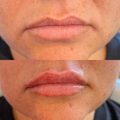 Lip Filler Female
