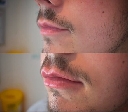 Lip Filler Male