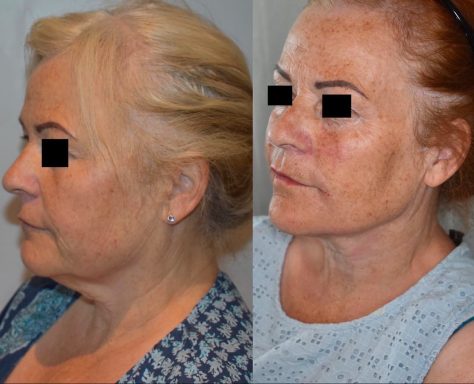 Full Facial Contouring